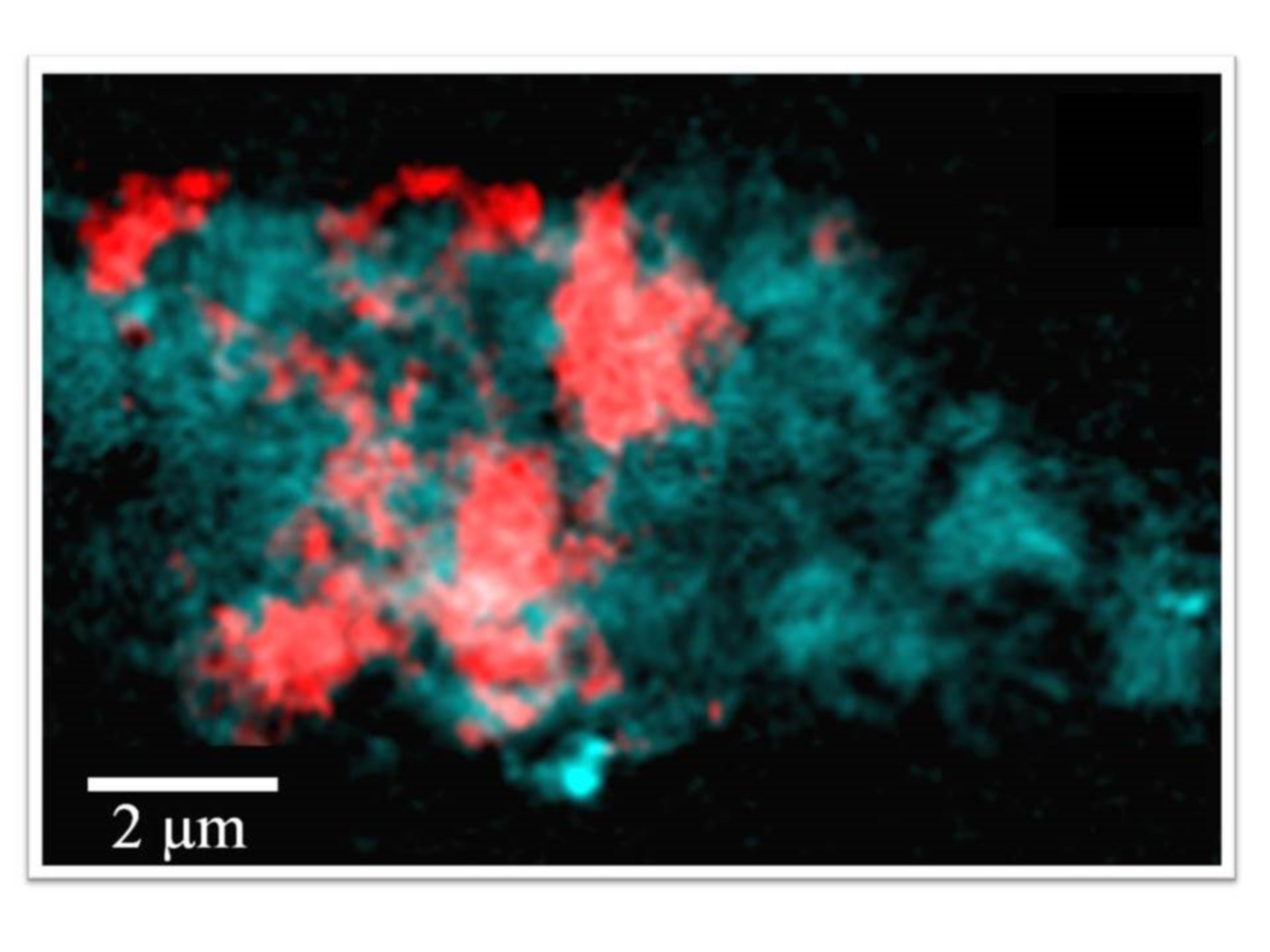Aggregation of iron (red) with beta-amyloid (blue)